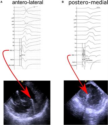 Frontiers Is Catheter Tissue Contact Force Value Important For